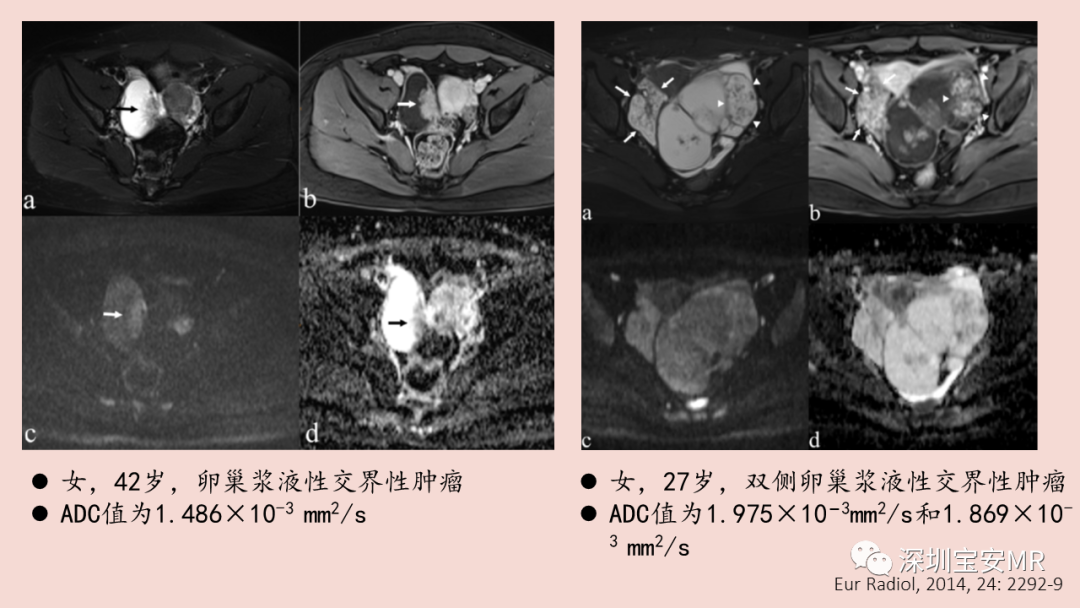 【PPT】卵巢交界性上皮性肿瘤MRI与病理对照-16
