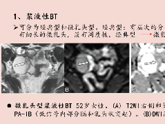 卵巢交界性上皮性肿瘤MRI与病理对照