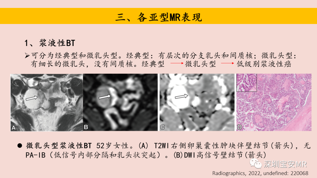 【PPT】卵巢交界性上皮性肿瘤MRI与病理对照-19