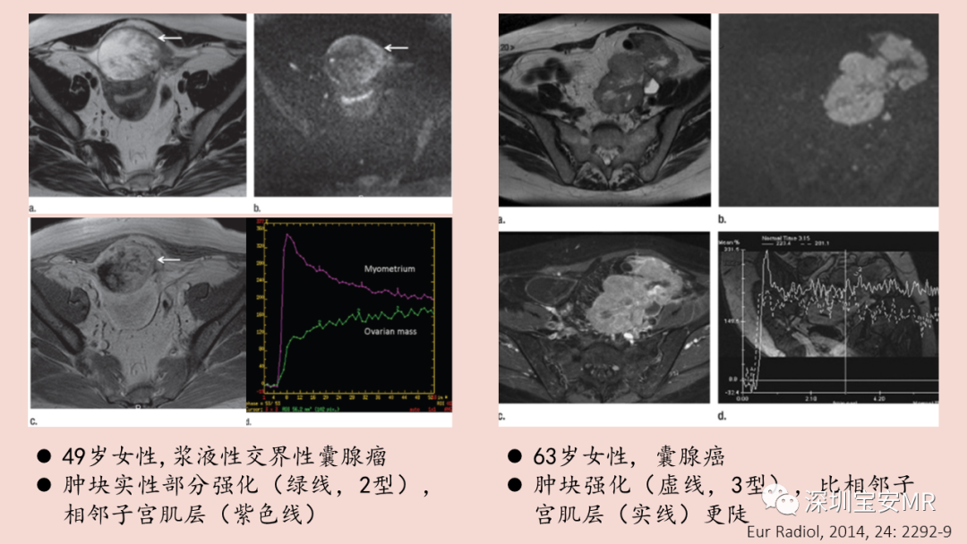 【PPT】卵巢交界性上皮性肿瘤MRI与病理对照-18