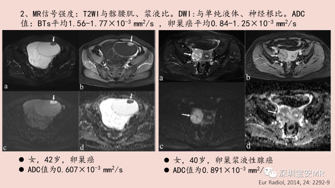 【PPT】卵巢交界性上皮性肿瘤MRI与病理对照-15