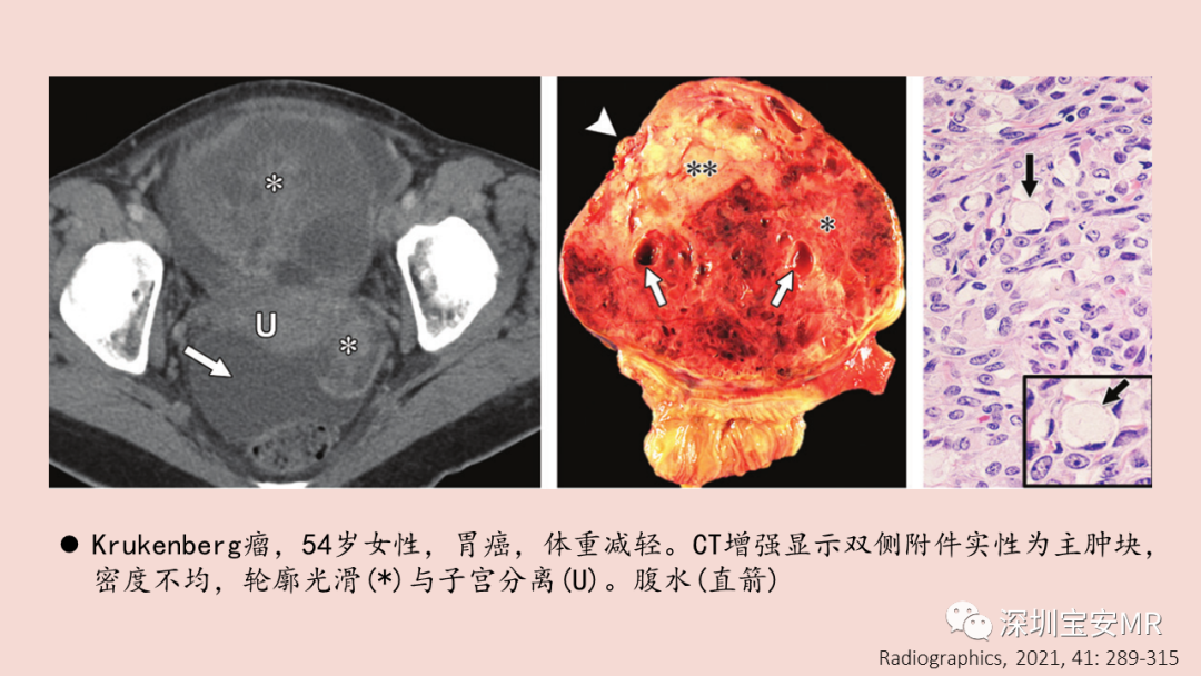 【PPT】卵巢交界性上皮性肿瘤MRI与病理对照-14