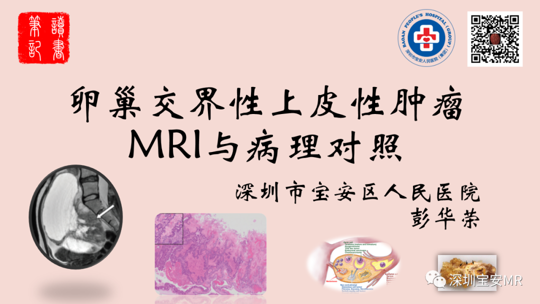 【PPT】卵巢交界性上皮性肿瘤MRI与病理对照-1
