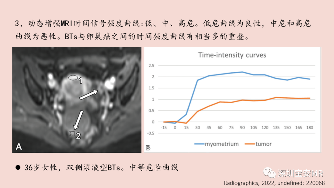 【PPT】卵巢交界性上皮性肿瘤MRI与病理对照-17