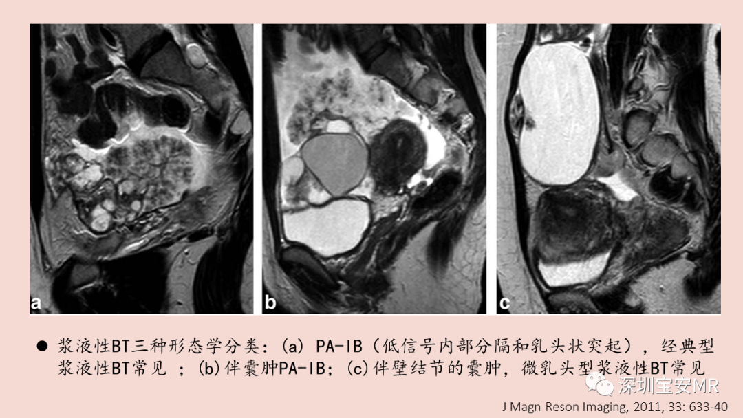 【PPT】卵巢交界性上皮性肿瘤MRI与病理对照-21