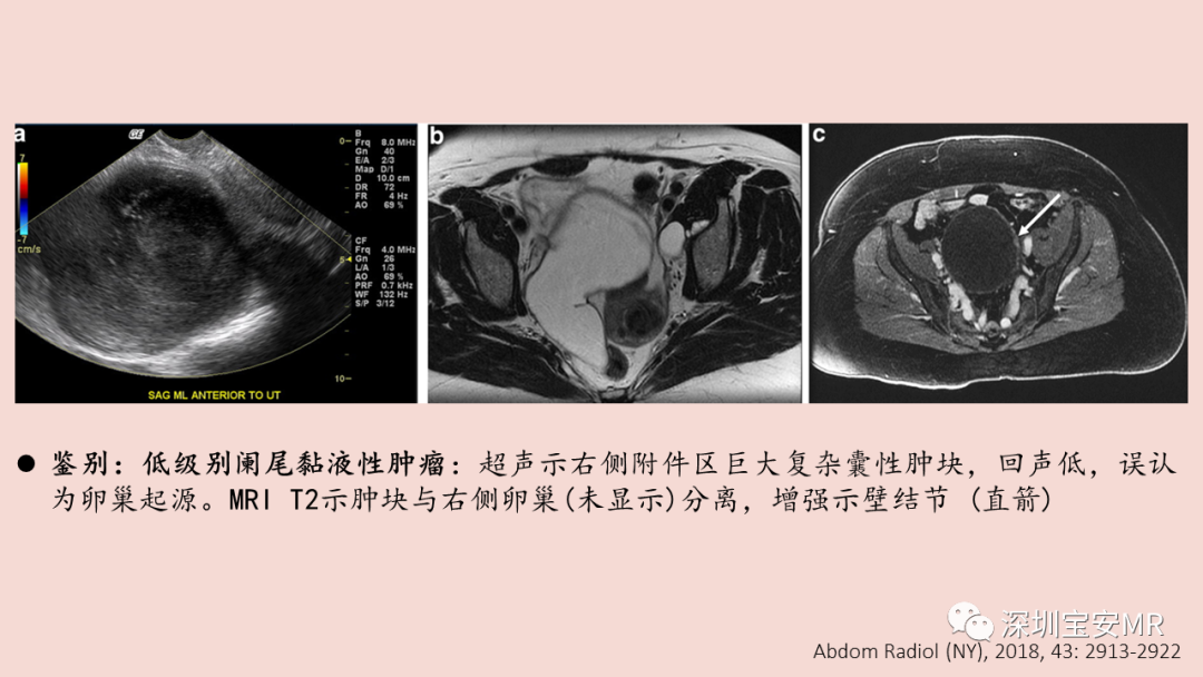 【PPT】卵巢交界性上皮性肿瘤MRI与病理对照-31