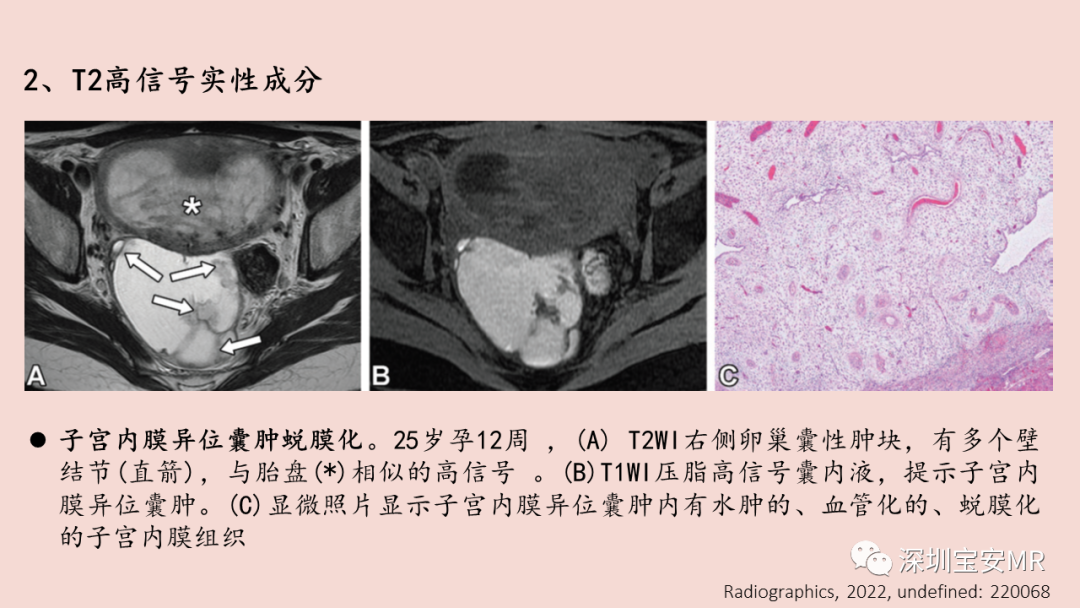 【PPT】卵巢交界性上皮性肿瘤MRI与病理对照-42
