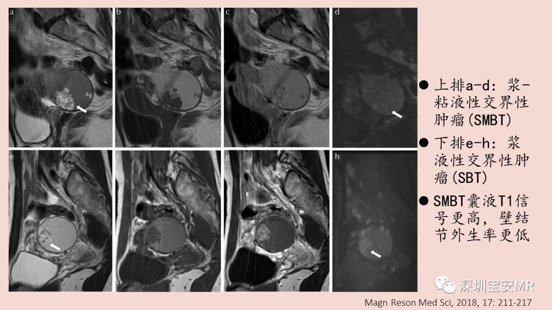 【PPT】卵巢交界性上皮性肿瘤MRI与病理对照-33