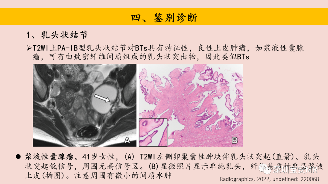 【PPT】卵巢交界性上皮性肿瘤MRI与病理对照-39