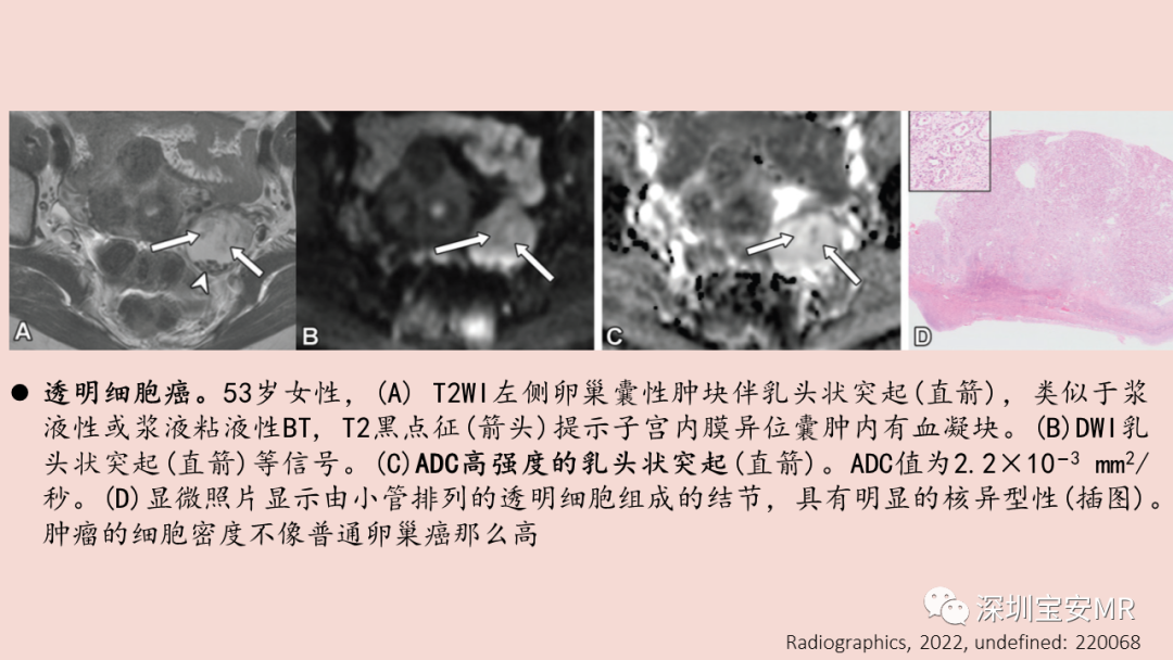 【PPT】卵巢交界性上皮性肿瘤MRI与病理对照-41