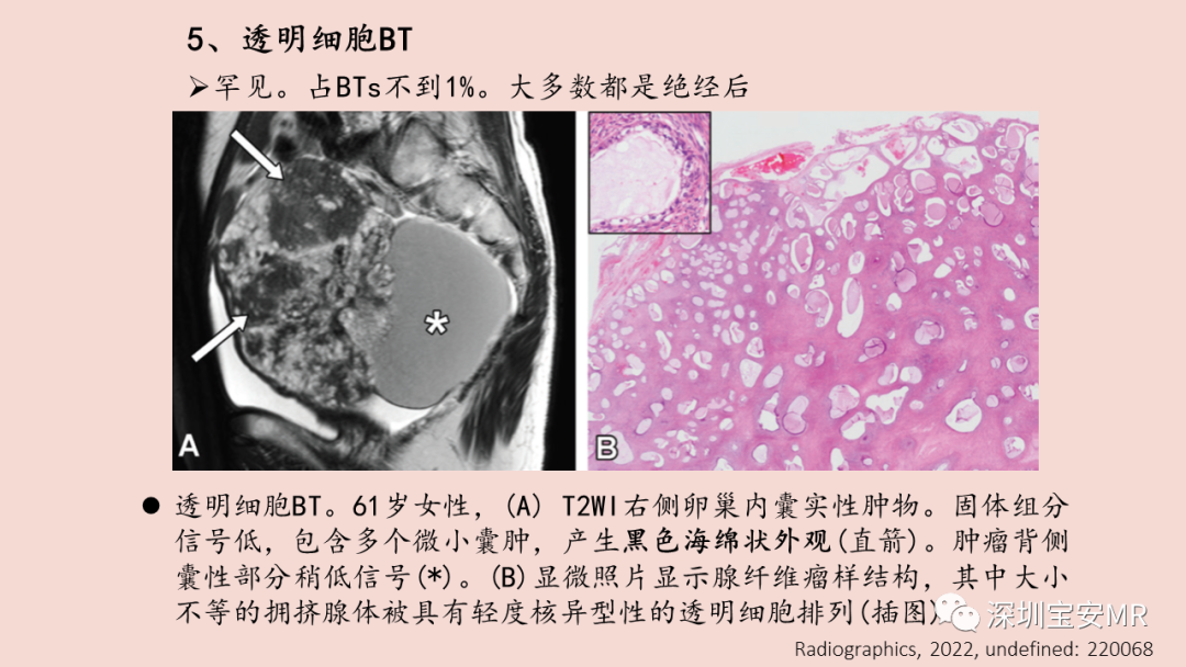 【PPT】卵巢交界性上皮性肿瘤MRI与病理对照-36