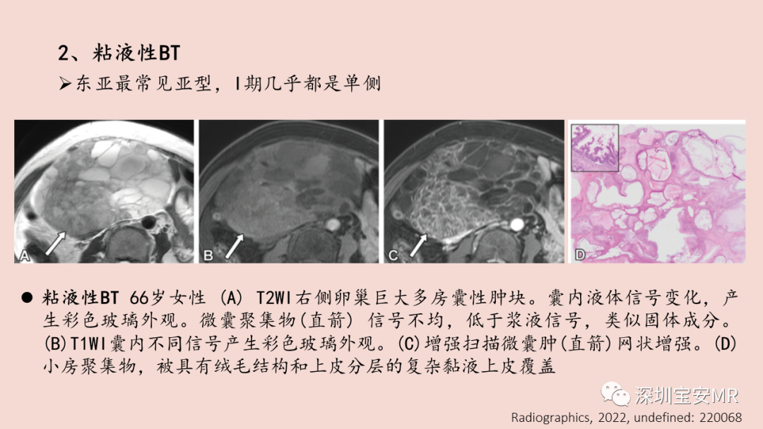 【PPT】卵巢交界性上皮性肿瘤MRI与病理对照-25