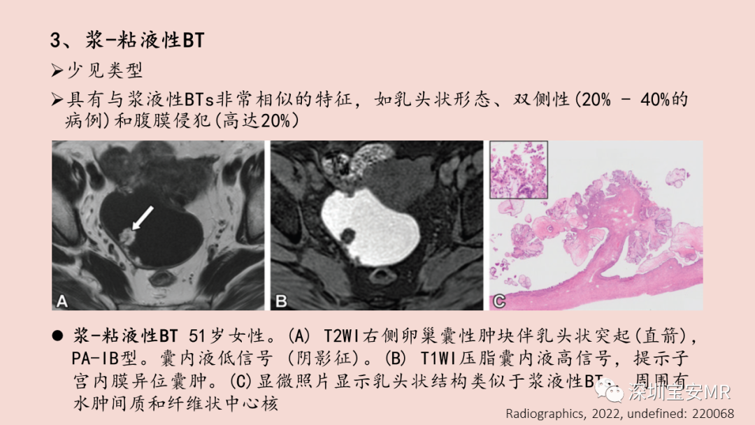 【PPT】卵巢交界性上皮性肿瘤MRI与病理对照-32