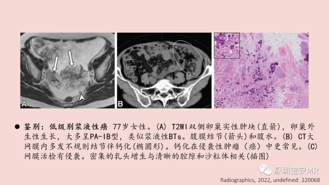 【PPT】卵巢交界性上皮性肿瘤MRI与病理对照-23