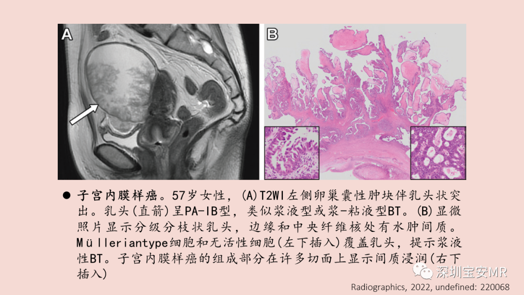 【PPT】卵巢交界性上皮性肿瘤MRI与病理对照-40