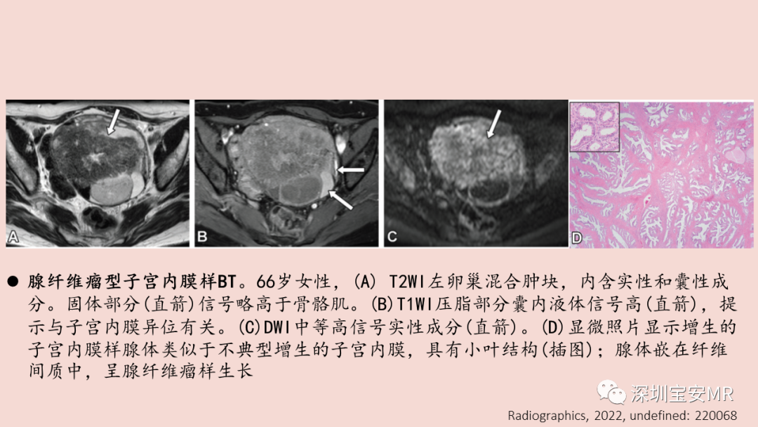 【PPT】卵巢交界性上皮性肿瘤MRI与病理对照-35