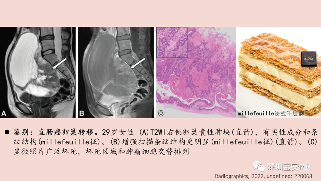 【PPT】卵巢交界性上皮性肿瘤MRI与病理对照-30