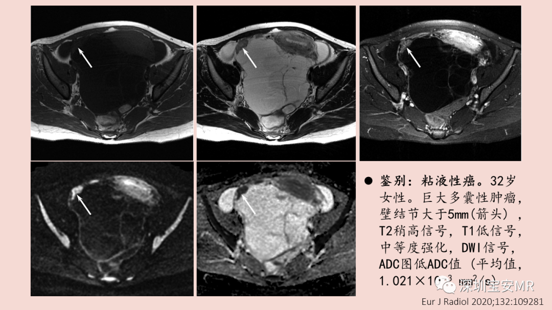 【PPT】卵巢交界性上皮性肿瘤MRI与病理对照-29