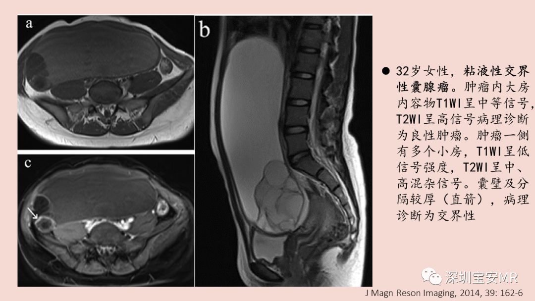 【PPT】卵巢交界性上皮性肿瘤MRI与病理对照-27