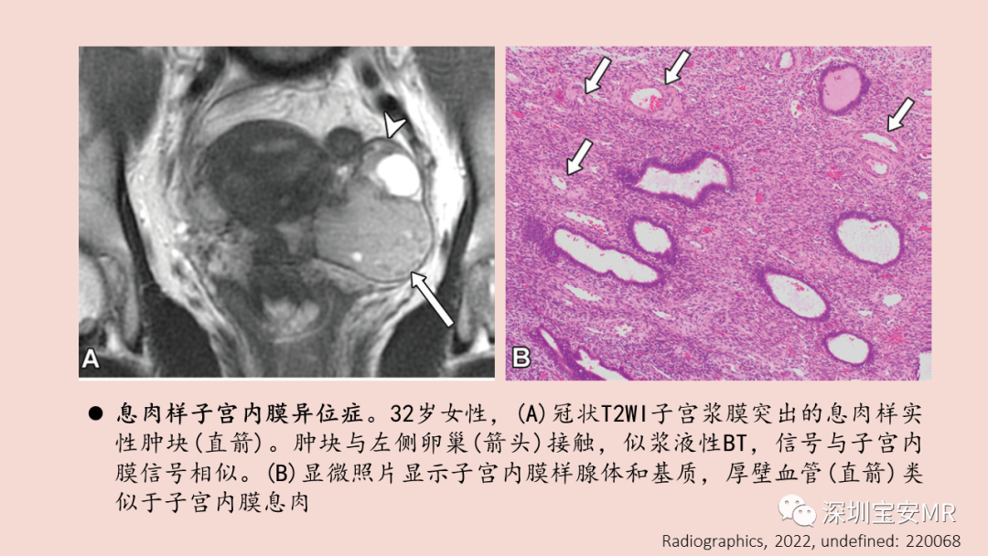 【PPT】卵巢交界性上皮性肿瘤MRI与病理对照-43