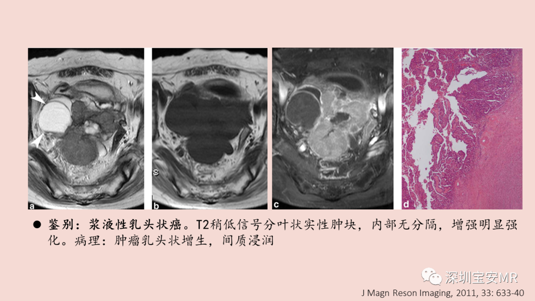 【PPT】卵巢交界性上皮性肿瘤MRI与病理对照-24
