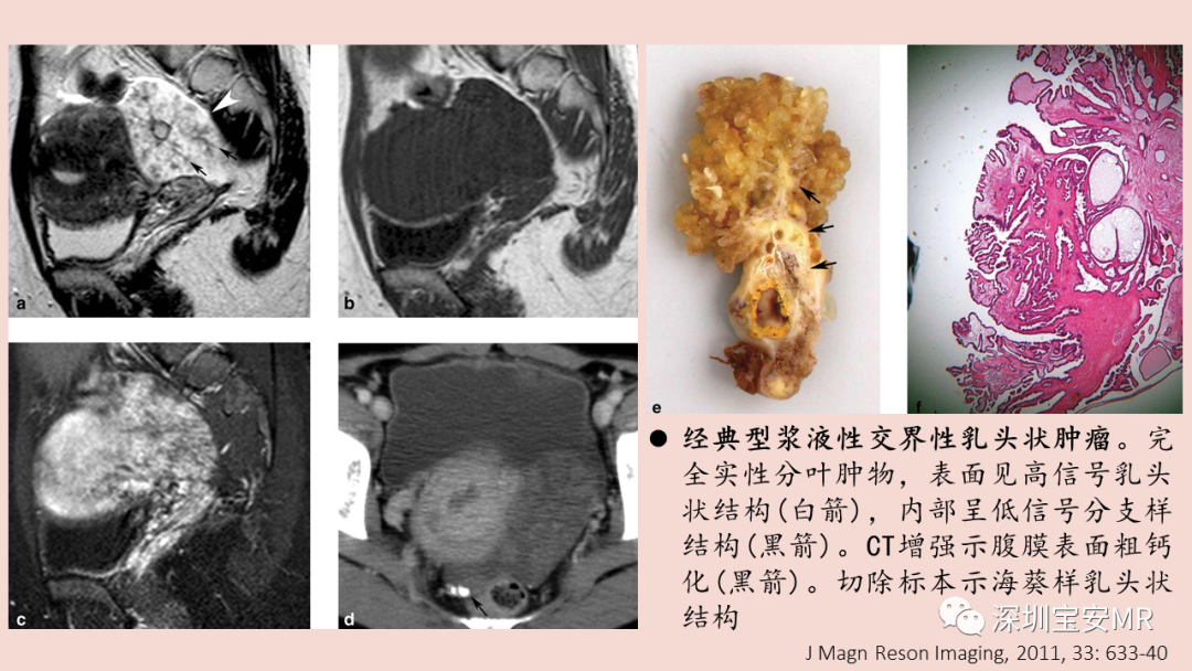 【PPT】卵巢交界性上皮性肿瘤MRI与病理对照-22