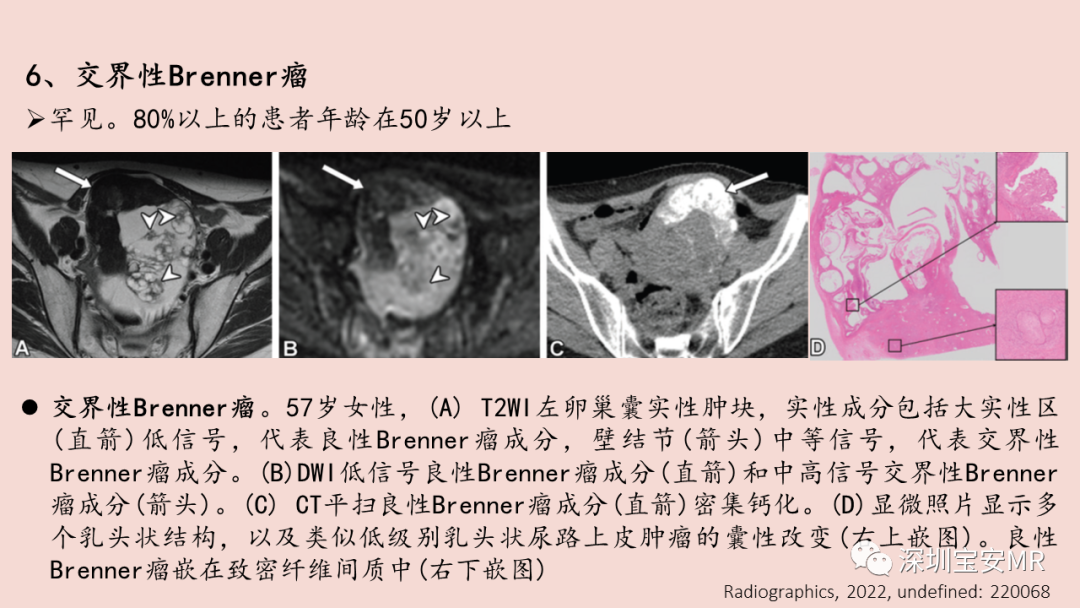 【PPT】卵巢交界性上皮性肿瘤MRI与病理对照-37