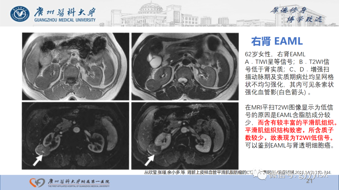 【PPT】肾少见肿瘤影像诊断的文献汇报-21