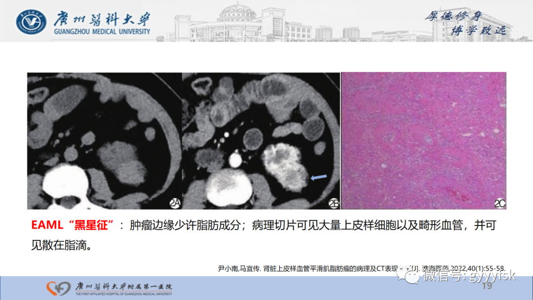 【PPT】肾少见肿瘤影像诊断的文献汇报-19