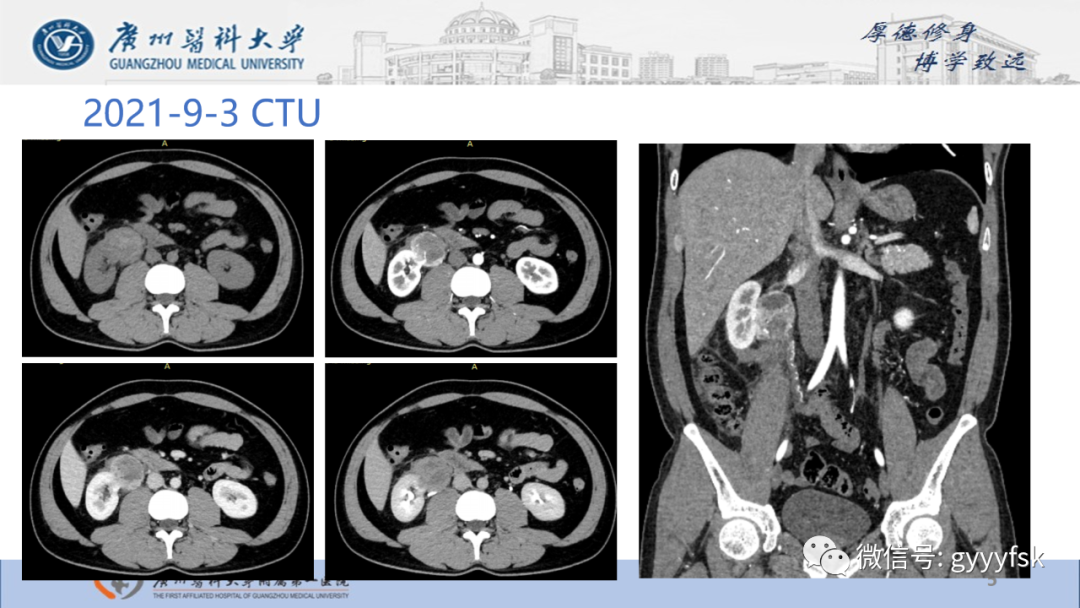 【PPT】肾少见肿瘤影像诊断的文献汇报-5