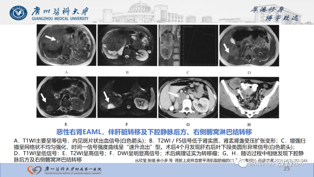 【PPT】肾少见肿瘤影像诊断的文献汇报-25
