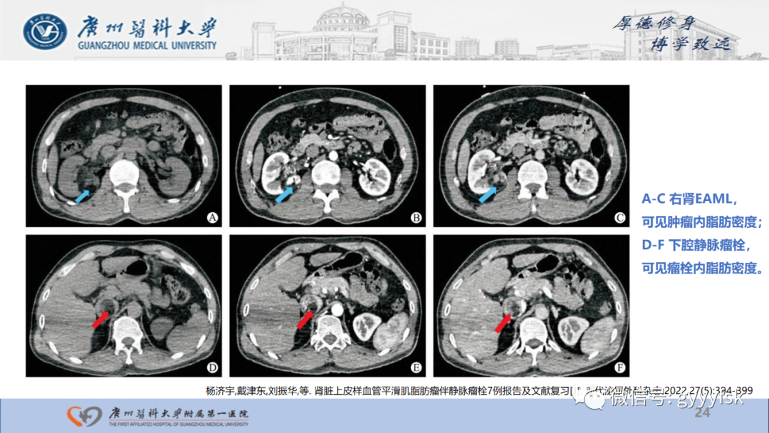 【PPT】肾少见肿瘤影像诊断的文献汇报-24