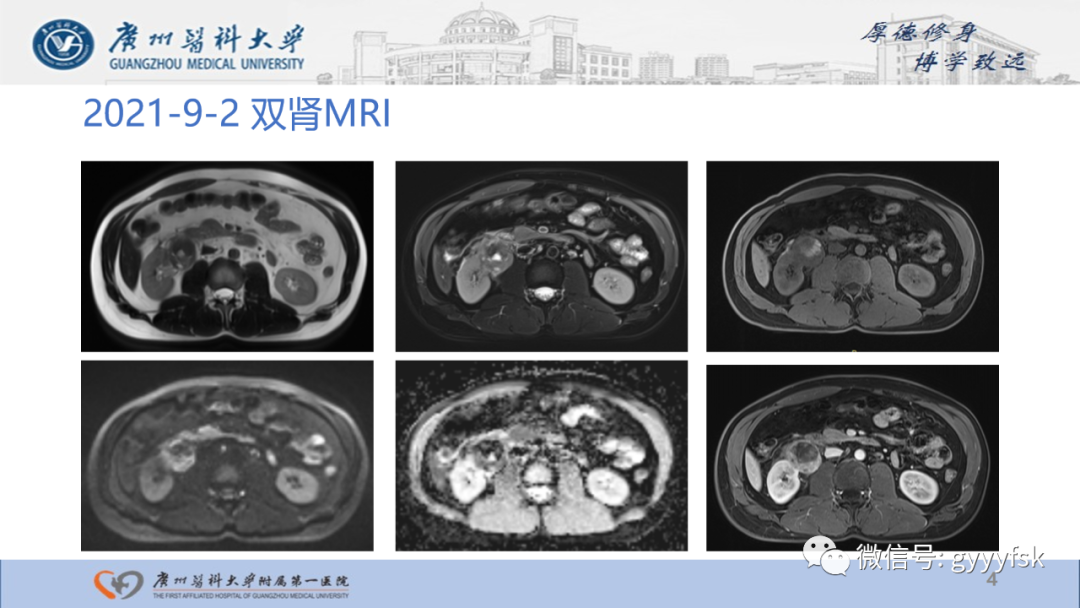 【PPT】肾少见肿瘤影像诊断的文献汇报-4