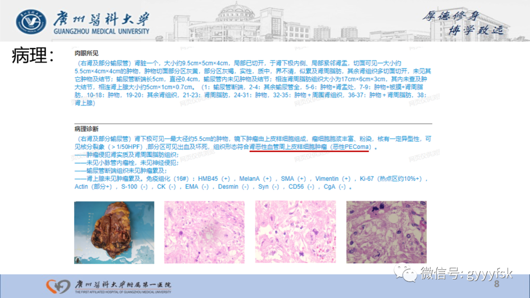 【PPT】肾少见肿瘤影像诊断的文献汇报-8