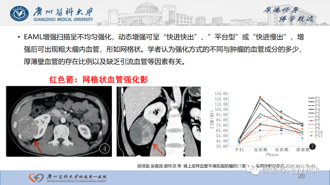【PPT】肾少见肿瘤影像诊断的文献汇报-20