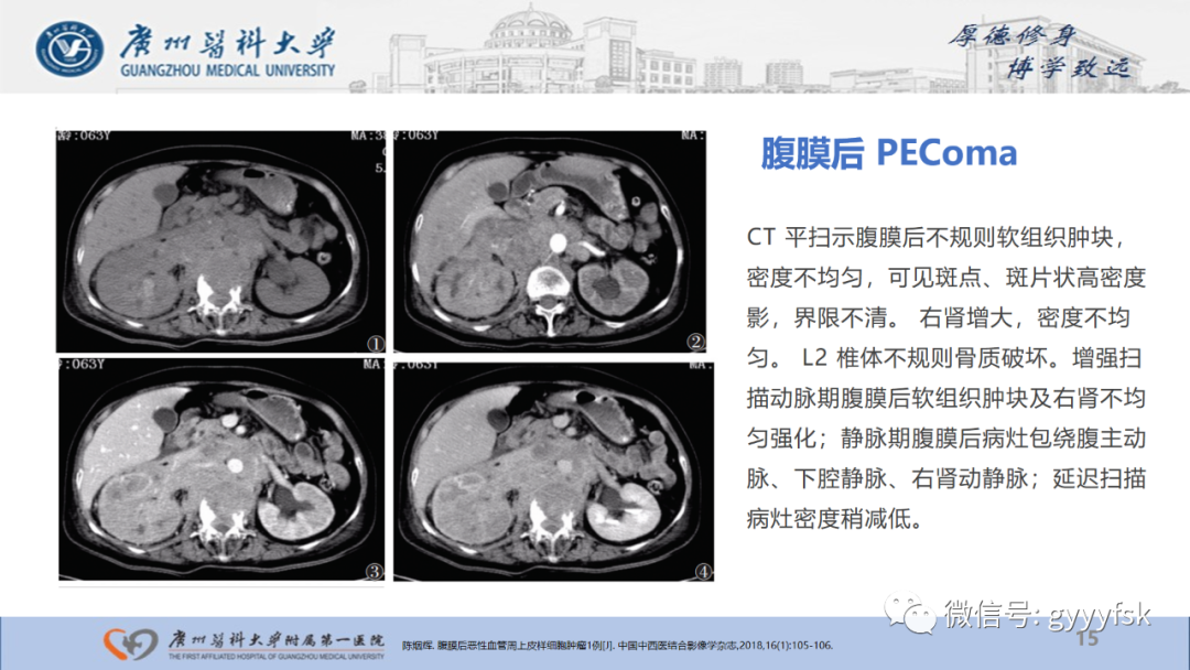 【PPT】肾少见肿瘤影像诊断的文献汇报-15