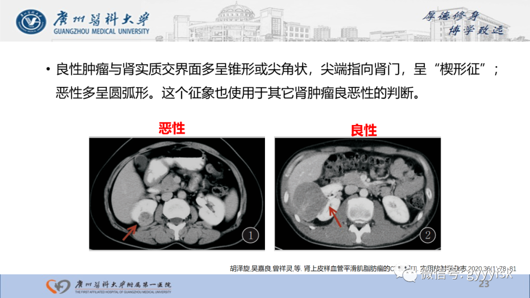 【PPT】肾少见肿瘤影像诊断的文献汇报-23