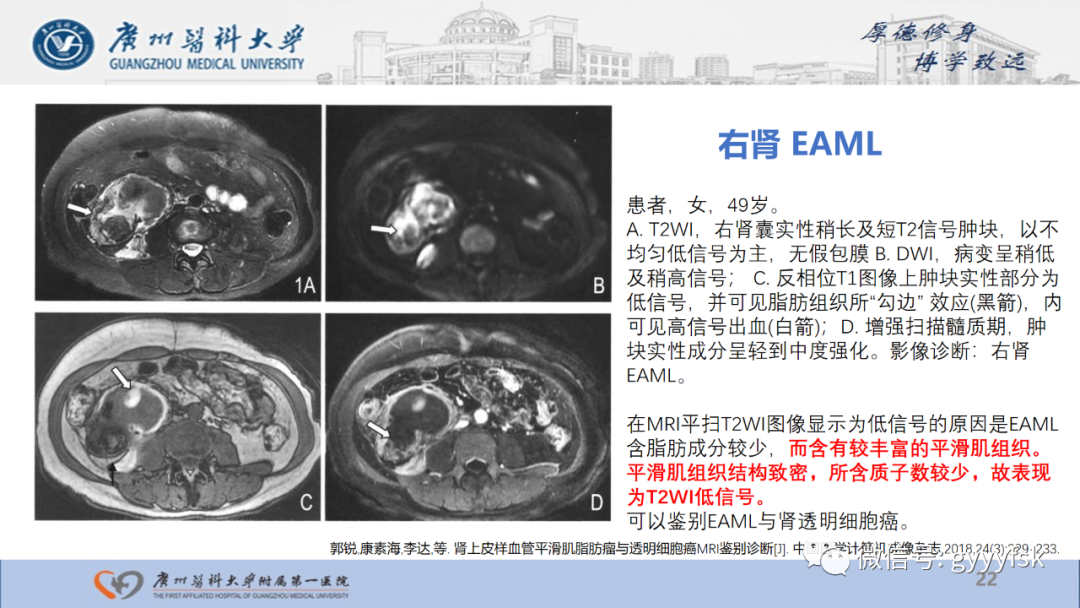 【PPT】肾少见肿瘤影像诊断的文献汇报-22