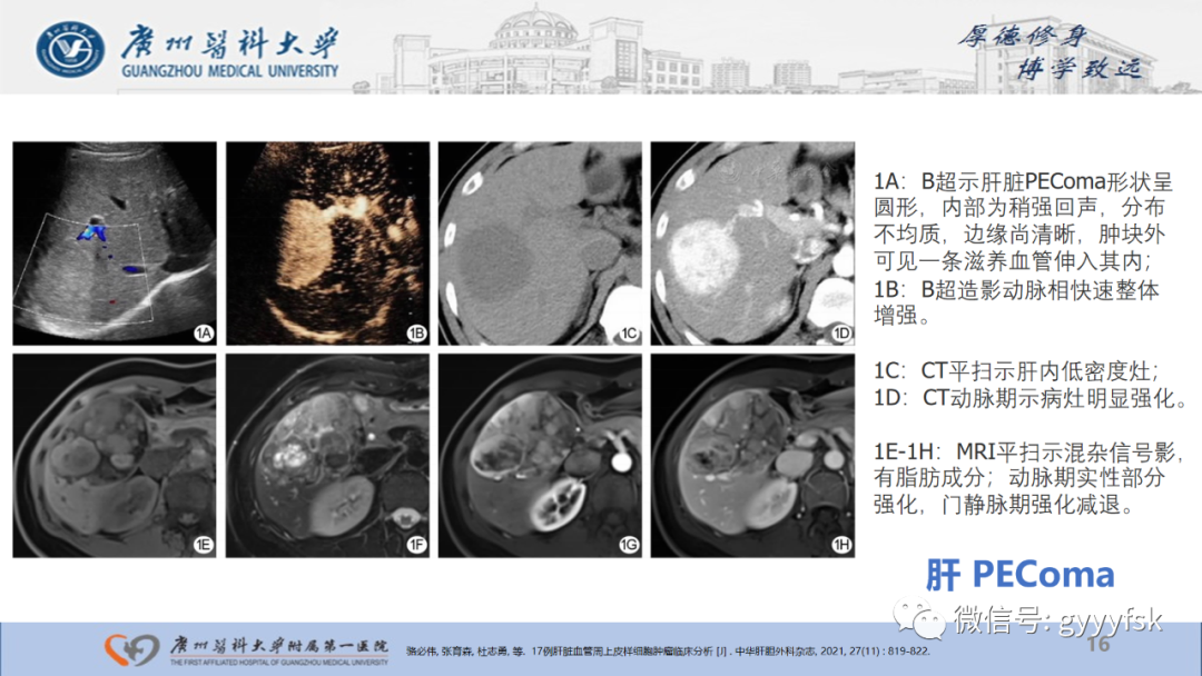 【PPT】肾少见肿瘤影像诊断的文献汇报-16