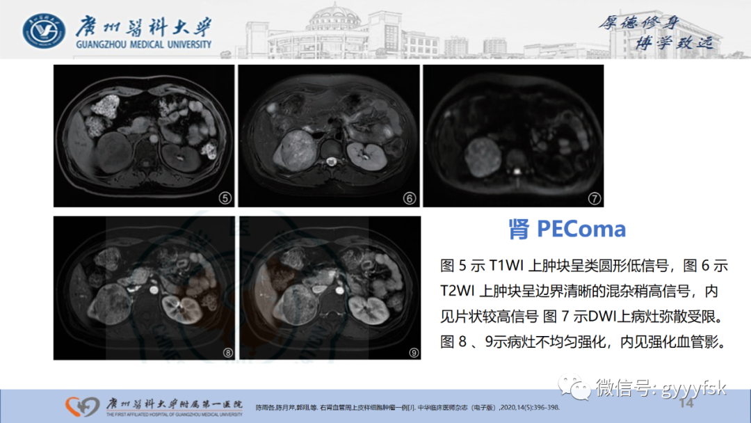【PPT】肾少见肿瘤影像诊断的文献汇报-14