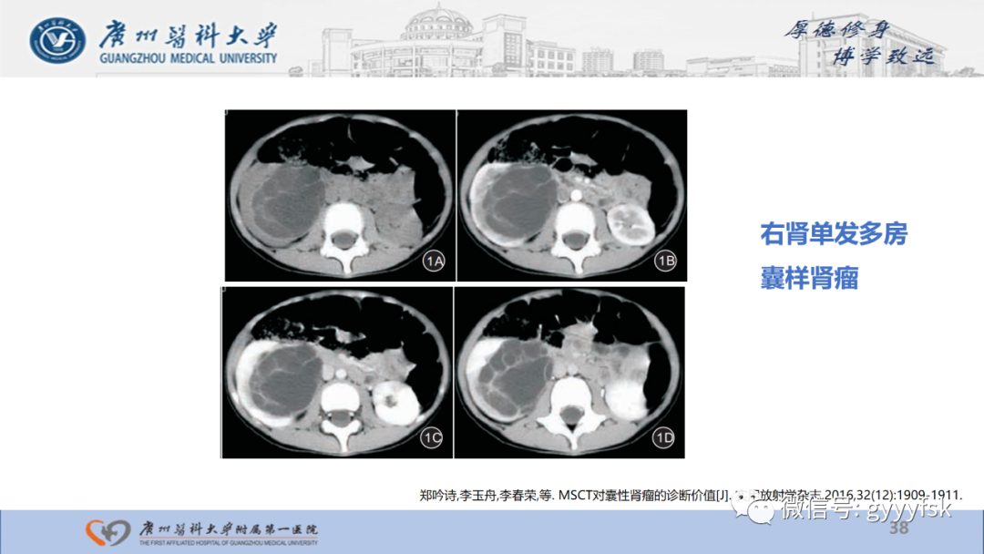 【PPT】肾少见肿瘤影像诊断的文献汇报-38