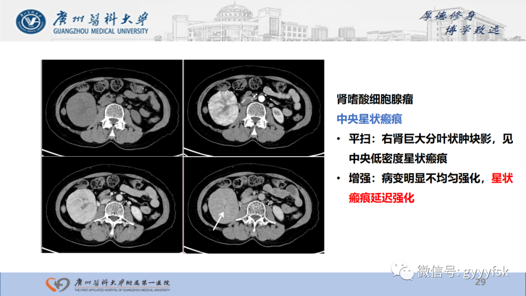 【PPT】肾少见肿瘤影像诊断的文献汇报-29