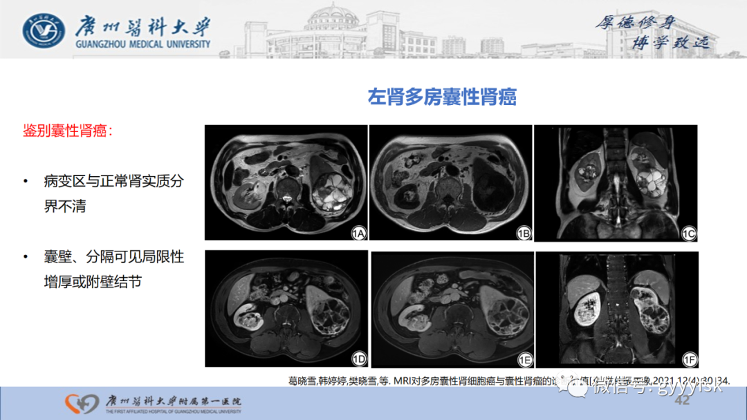 【PPT】肾少见肿瘤影像诊断的文献汇报-42