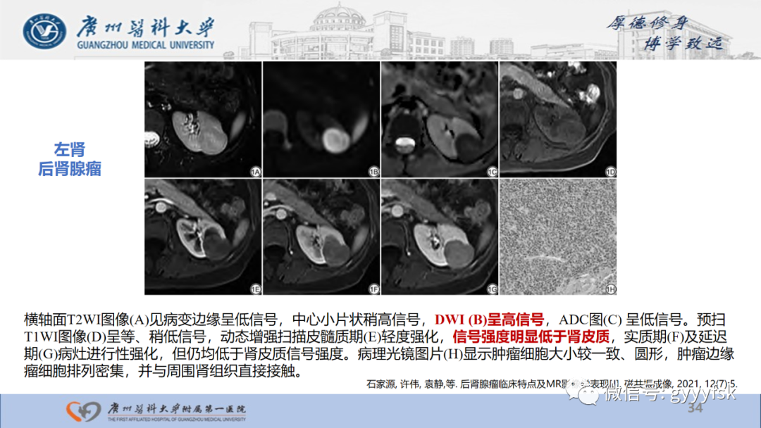 【PPT】肾少见肿瘤影像诊断的文献汇报-34