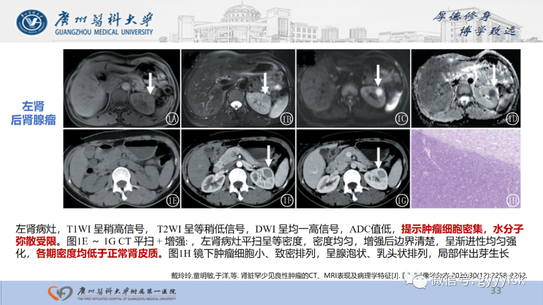 【PPT】肾少见肿瘤影像诊断的文献汇报-33