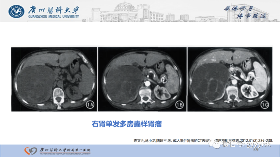 【PPT】肾少见肿瘤影像诊断的文献汇报-39