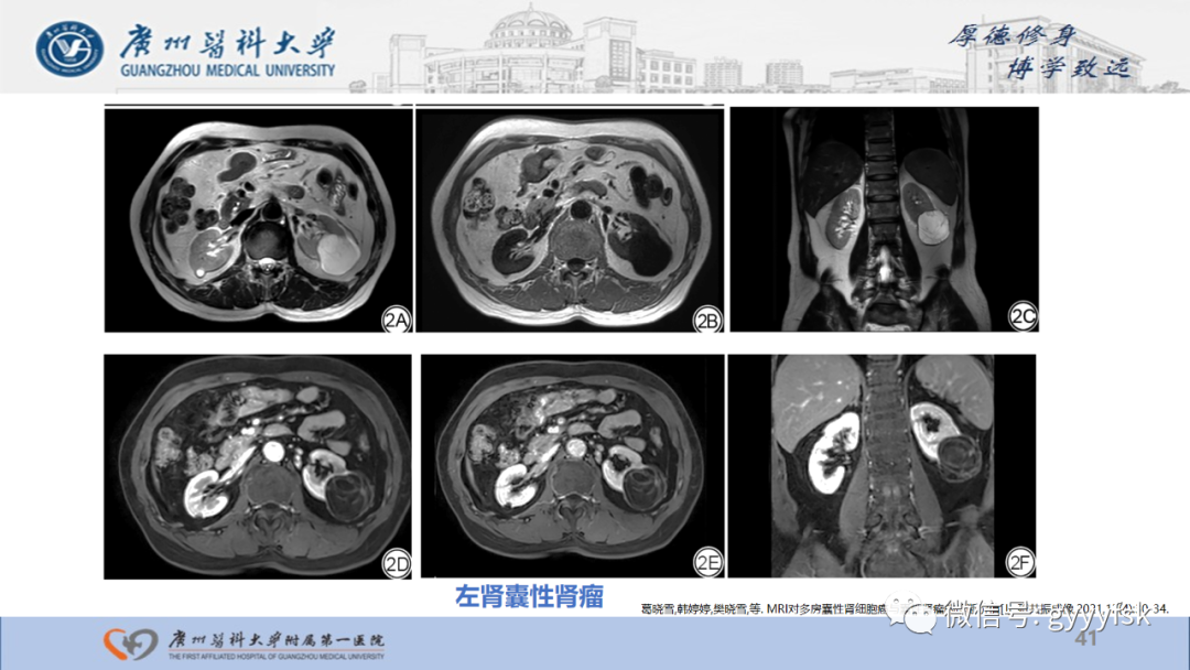 【PPT】肾少见肿瘤影像诊断的文献汇报-41