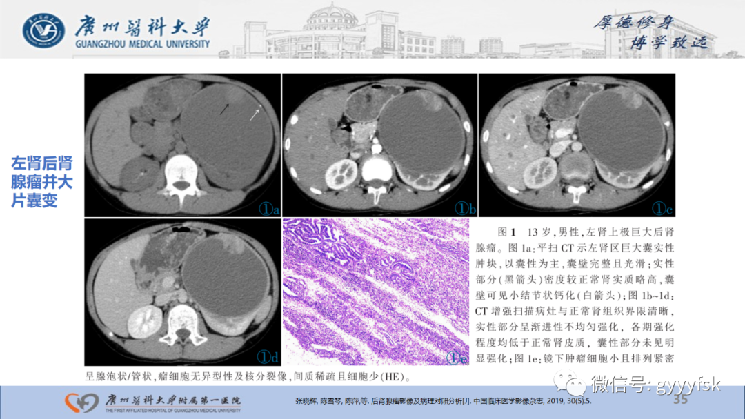 【PPT】肾少见肿瘤影像诊断的文献汇报-35