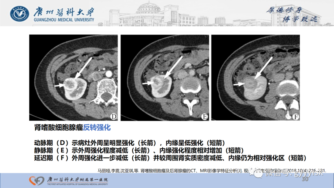 【PPT】肾少见肿瘤影像诊断的文献汇报-30
