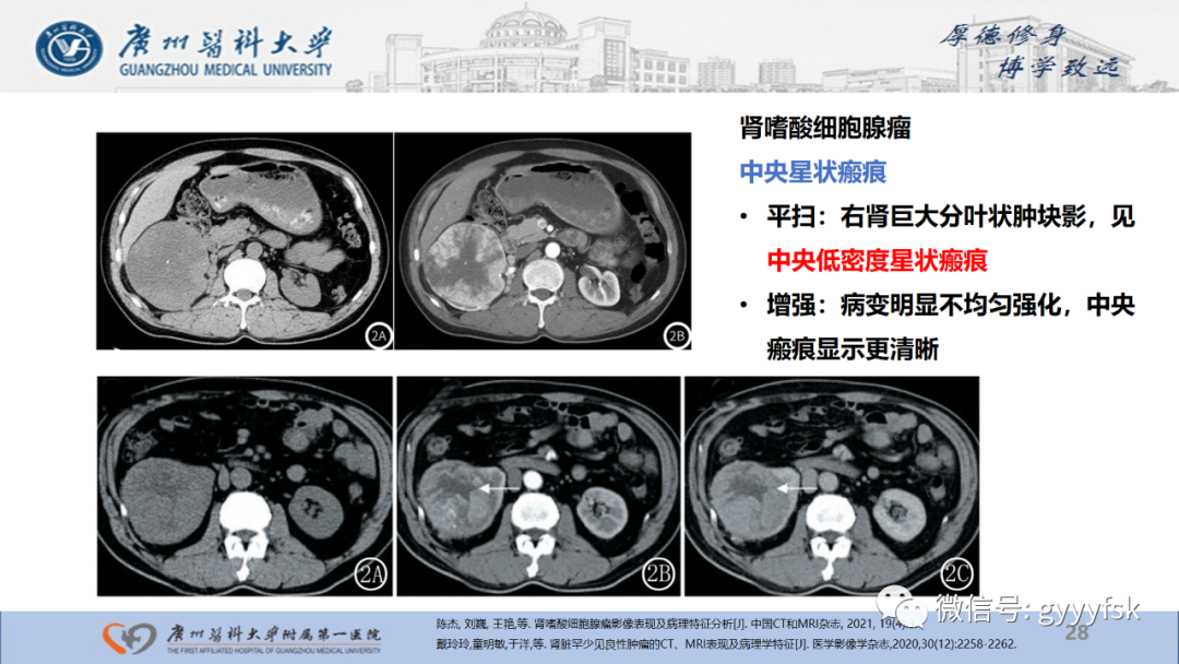 【PPT】肾少见肿瘤影像诊断的文献汇报-28